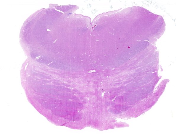 8C1 Multiple system atrophy (MSA, Case 8) Pons H&E whole mount