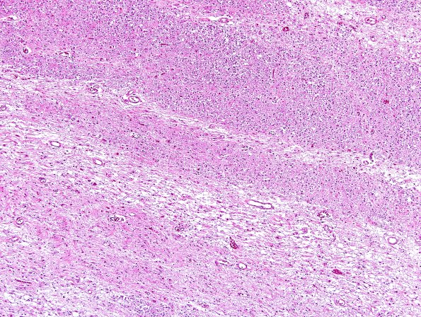 8C2 Multiple system atrophy (MSA, Case 8) Pons H&E 4.jpg