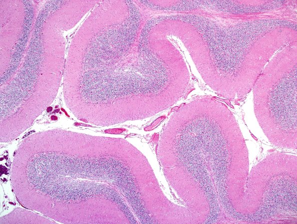 8D1 Multiple system atrophy (MSA, Case 8) Cbell H&E 3.jpg