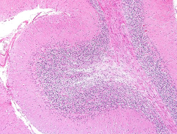 8D2 Multiple system atrophy (MSA, Case 8) Cbell H&E 5.jpg