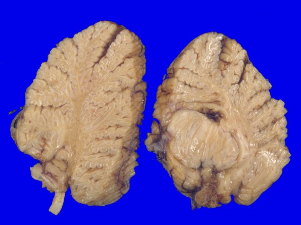 9A9 MSA (Case 9) A2