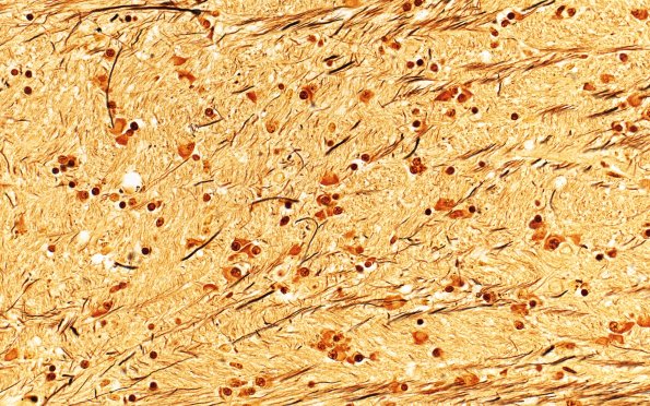 9B3A MSA (Case 9) N25 Biels 40X int capsule