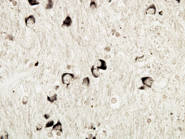 9B5 MSA (Case 9) basal ganglia int capsule Gallyas 2