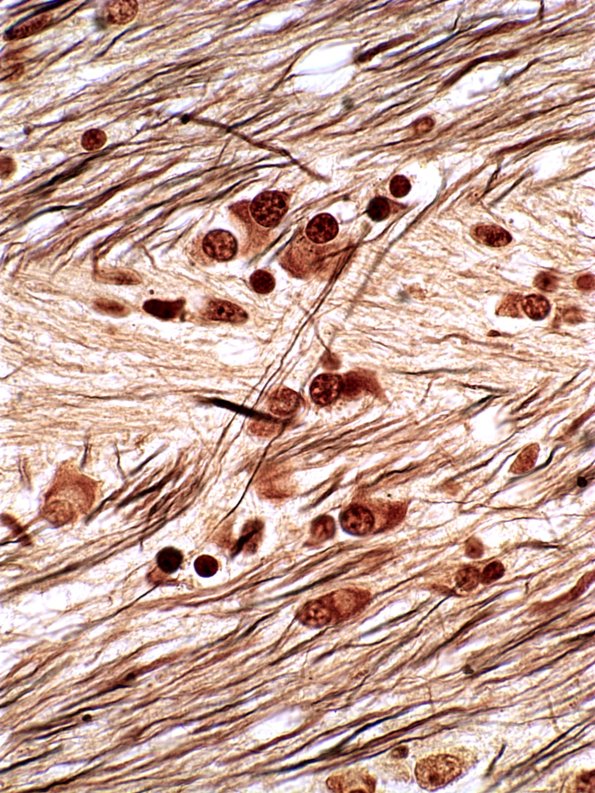 9C3C MSA (Case 9) Bielschowsky