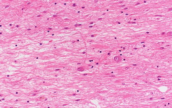 9C4B MSA (Case 9) N14 Biels 10X