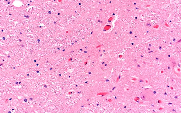 9F4 MSA IML (Case 9) H&E 40X 1