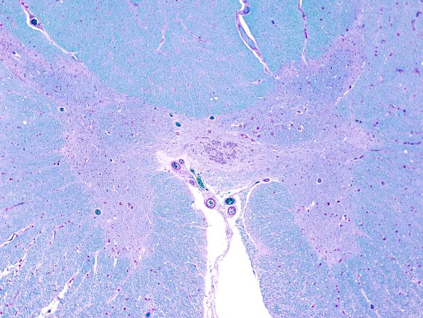 9F5 MSA (Case 9) Thoracic IML LFB-PAS 1