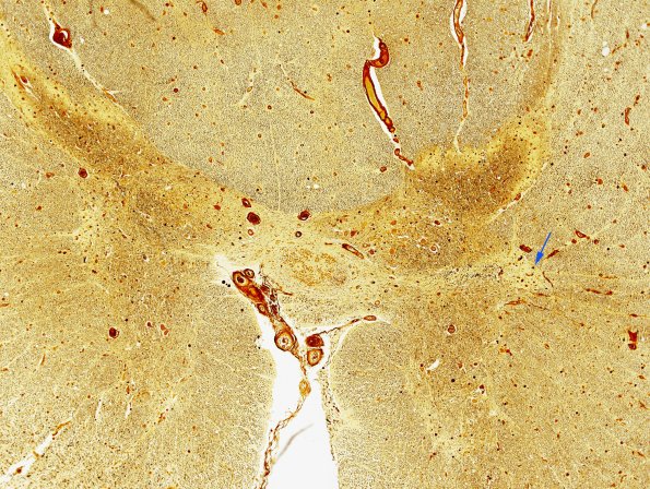 9F6 MSA (Case 9) Thoracic IML Biels 2 copy