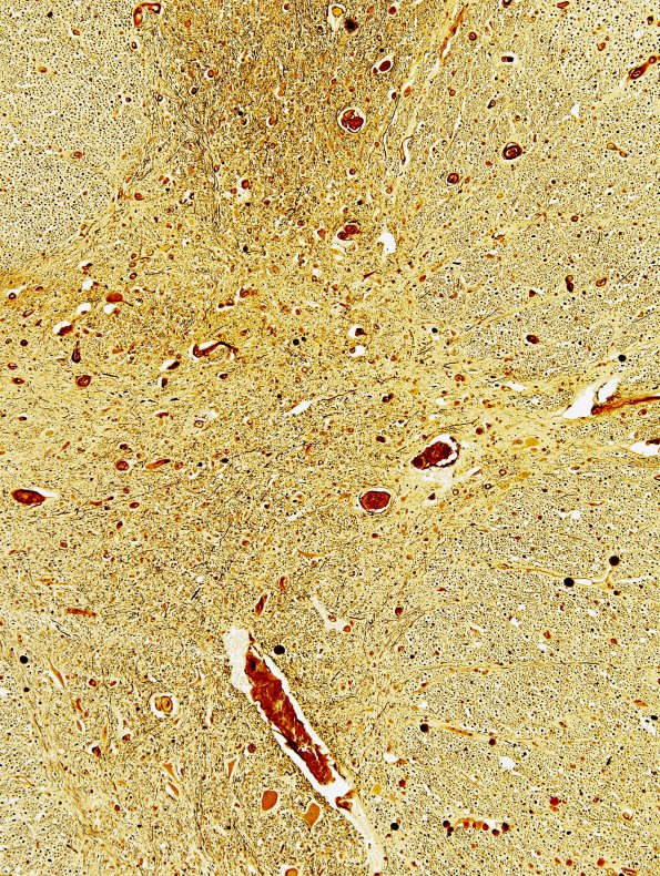 9F7 MSA (Case 9) Thoracic IML Biels 3