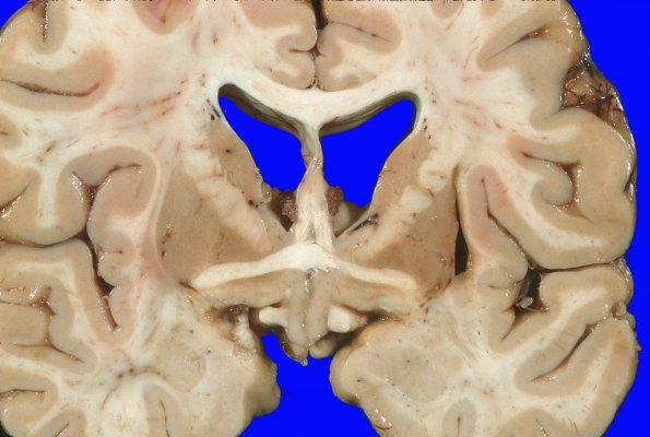 2A2 Hallervorden Spatz Dz (NBIA, Case 2) 2