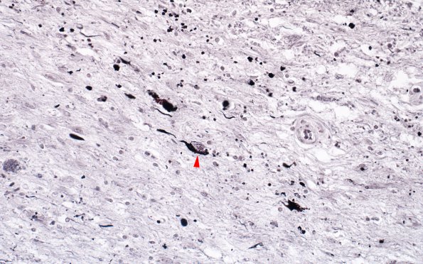 2I3 Hallervorden Spatz Dz (NBIA, Case 2) N6 Gallyas 40X 4 copy