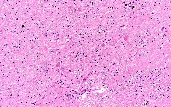 3B3 Hallervorden-Spatz Dz (Case 3) L17 GP H&E 20X