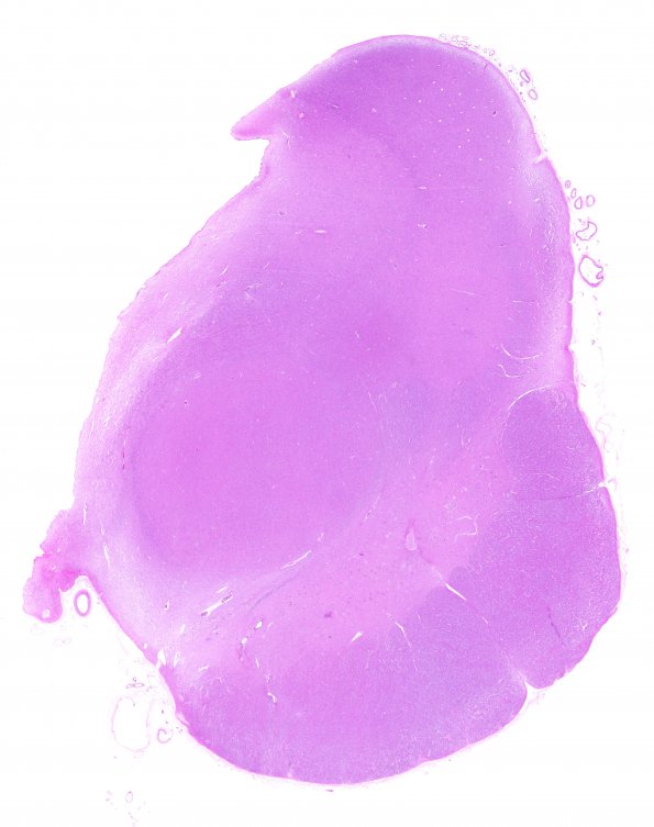 3E1 HSDz (Case 3) L9 H&E WM