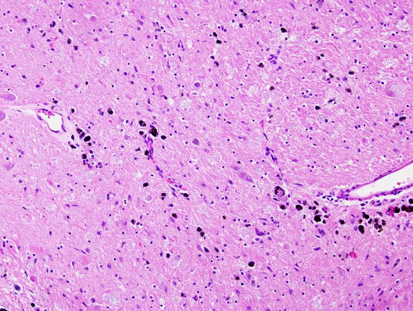 3E3 Hallervorden-Spatz Dz (Case 3) H&E Midbrain 2