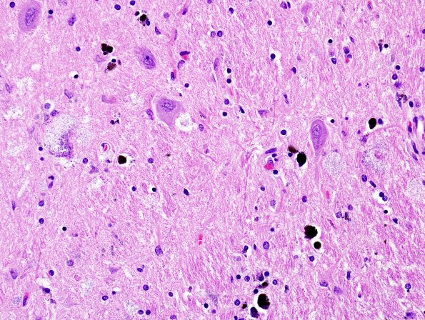 3E5 Hallervorden-Spatz Dz (Case 3) H&E Midbrain 1