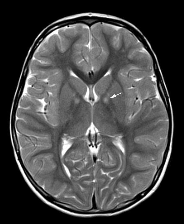 4A1 HSD (Case 4) T2 no C copy