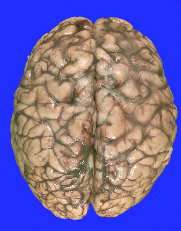 4B1 Hallervorden-Spatz Disease (Case 4)_2