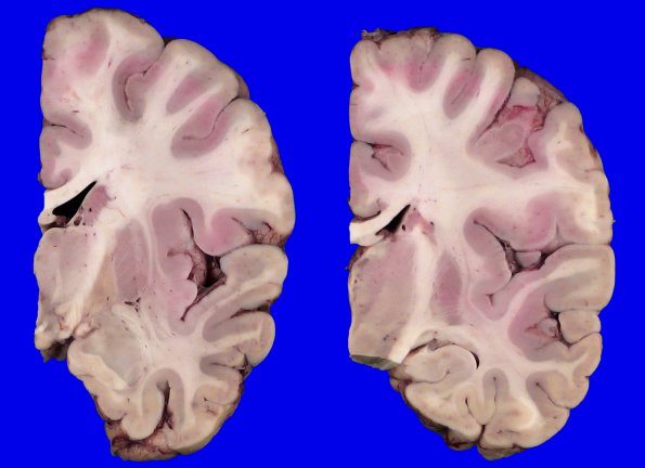 4B4 Hallervorden-Spatz Disease (Case 4)_4