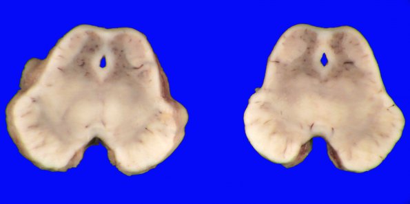 4B6 Hallervorden-Spatz Disease (Case 4)_7