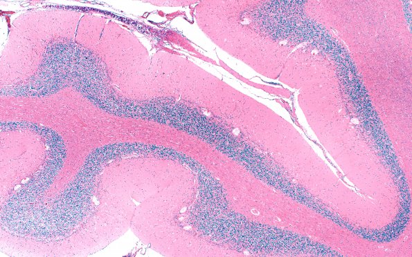 4D1 Hypoxia-ischemia, PANK case (Case 4) H&E 2