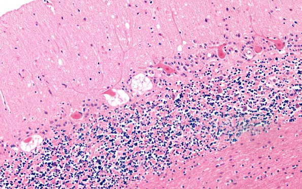 4D2 Hypoxia-ischemia, PANK case (Case 4) H&E 3