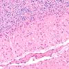 4D3 Hypoxia-ischemia, PANK case (Case 4) H&E 1