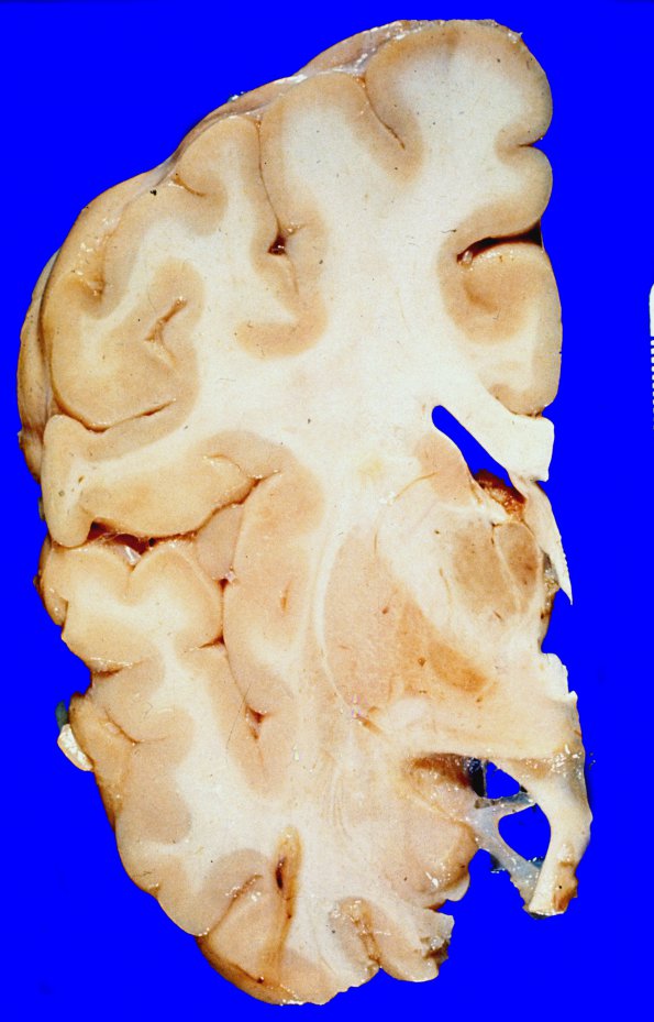 7A1 Hallervorden-Spatz Dz (Case 7) 3A