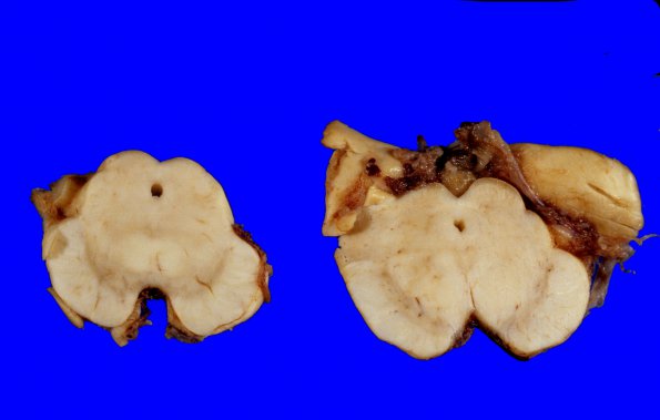 8A8 Hallervorden-Spatz Dz (Case 8) 1