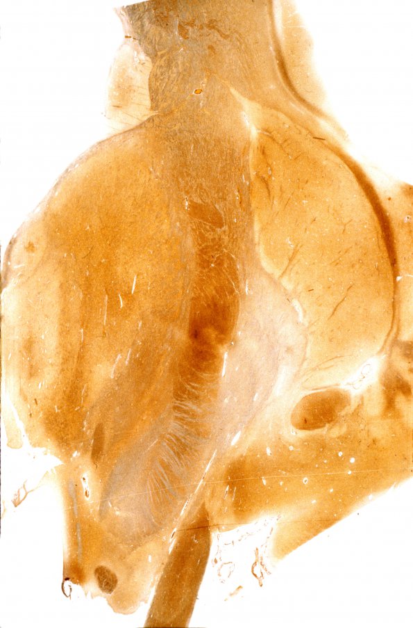 8D4 NBIA1 (HSDz) (Case 8) Biels