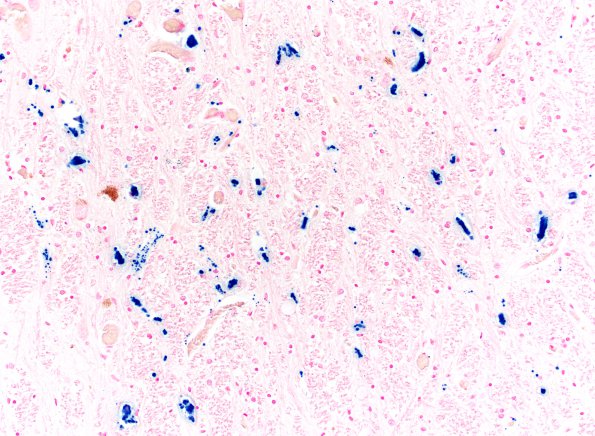 9C6 HSDz (Case 9) L10 Fe 20X