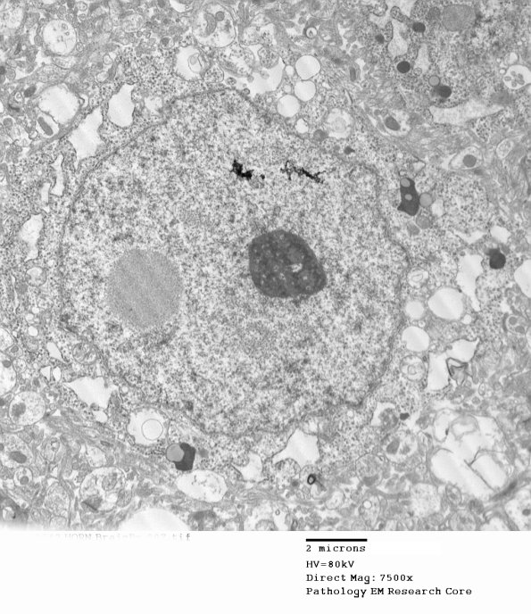 1E1 (Case 1) BrainBx EM007 - Copy