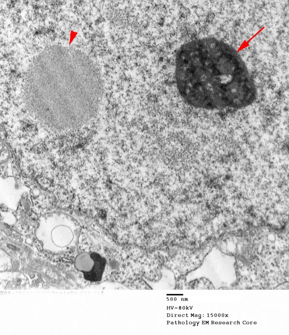 1E2 (Case 1) BrainBx EM008 - Copy