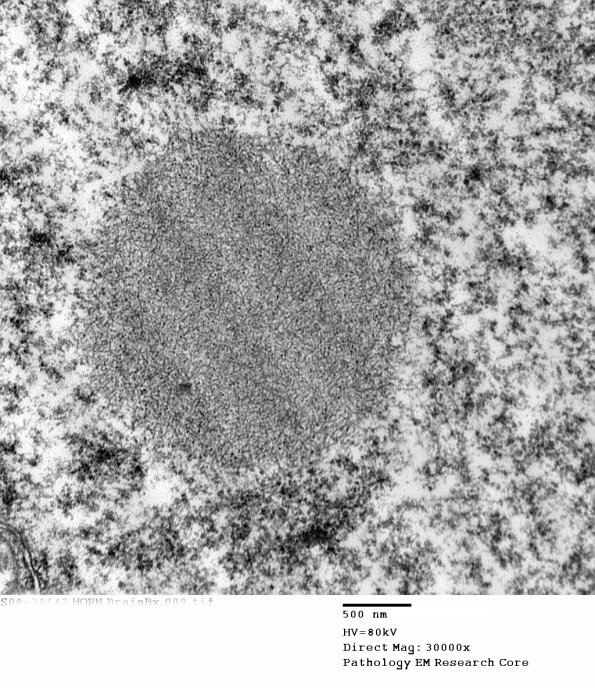 1E3 (Case 1) BrainBx EM009 - Copy