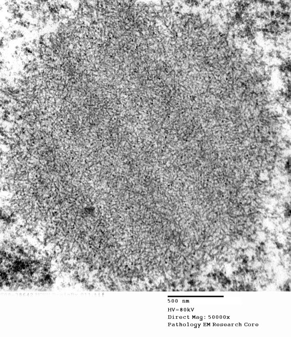 1E4 (Case 1) BrainBx EM011 - Copy