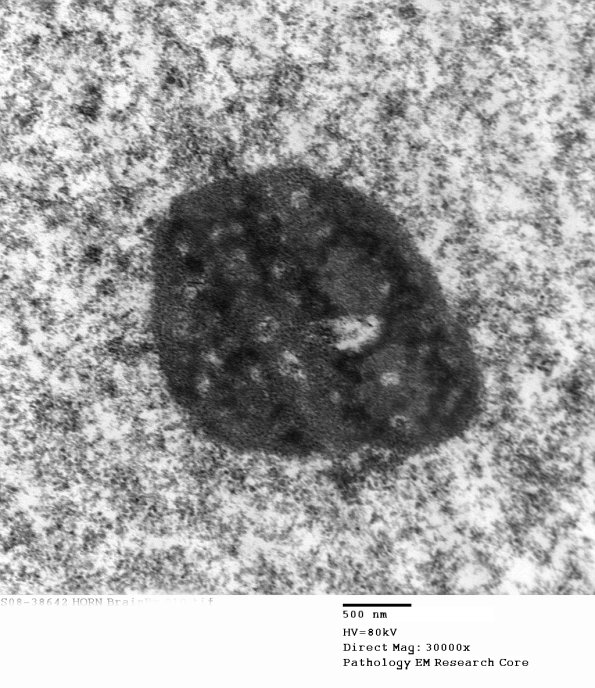 1E5 (Case 1) BrainBx EM010 - Copy