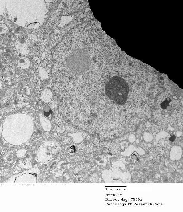 1E6 (Case 1) BrainBx EM018 - Copy