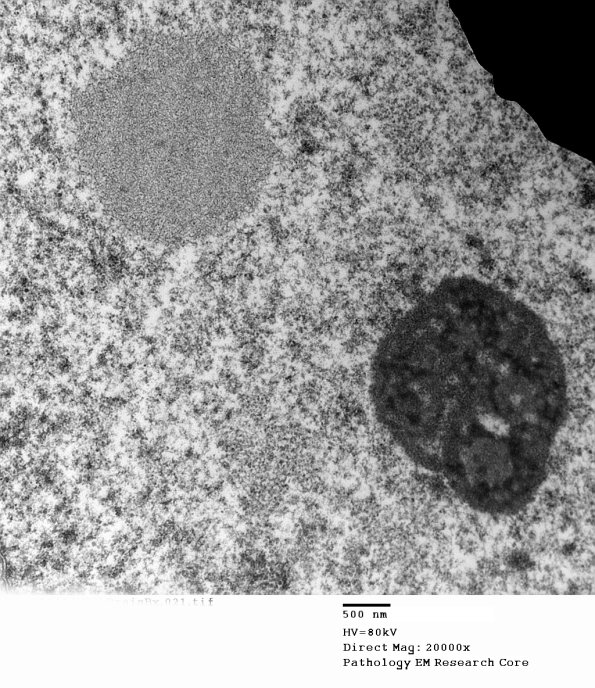 1E7 (Case 1) BrainBx EM021 - Copy