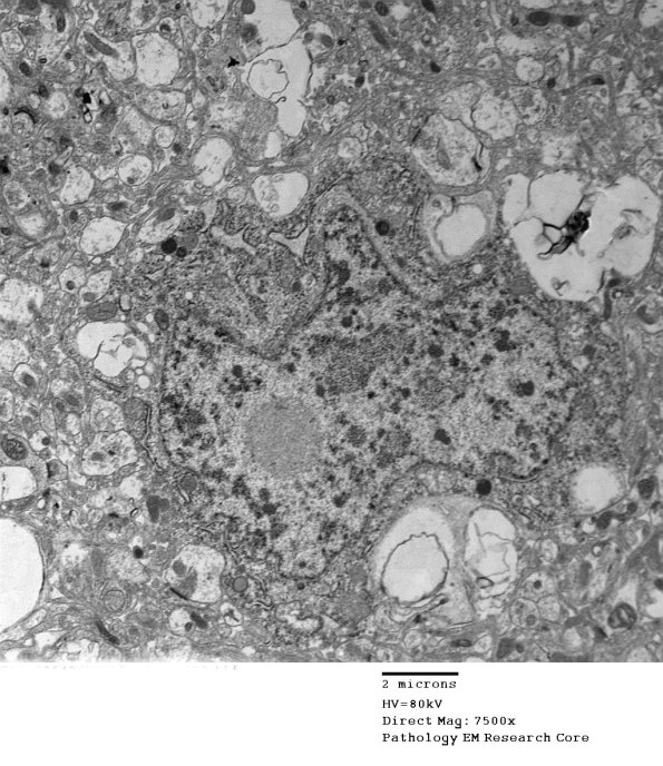 1E9 (Case 1) BrainBx EM023A - Copy