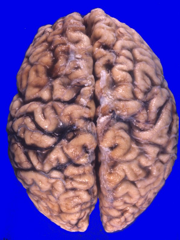 2A1 NIID & Alzheimer Dz (NIID, Case 2) A9