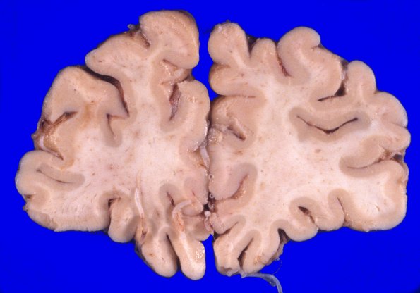 2A3 NIID & Alzheimer Dz (NIID, Case 2) A5