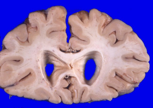 2A4 NIID & Alzheimer Dz (NIID, Case 2) A2