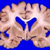 2A5 NIID & Alzheimer Dz (NIID, Case 2) A4