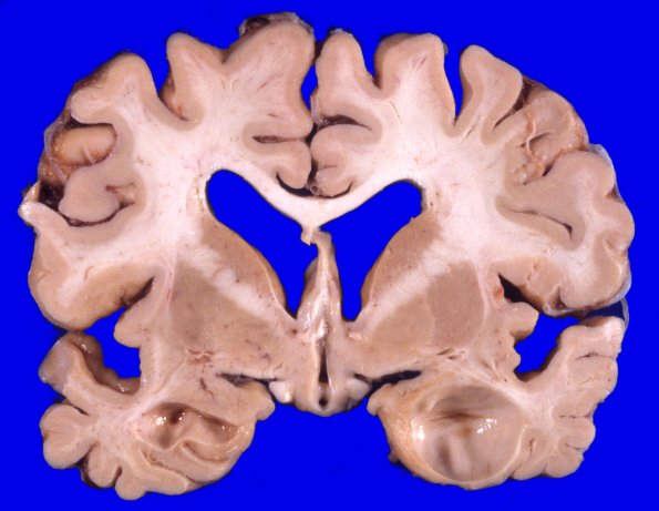 2A5 NIID & Alzheimer Dz (NIID, Case 2) A4