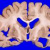 2A6 NIID & Alzheimer Dz (NIID, Case 2) A8