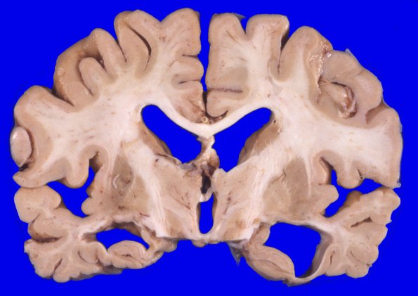 2A6 NIID & Alzheimer Dz (NIID, Case 2) A8