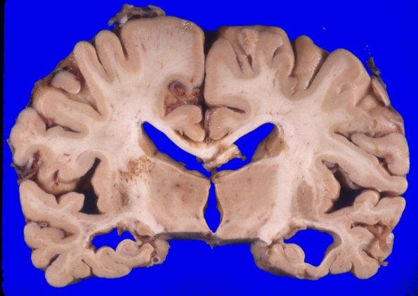 2A7 NIID & Alzheimer Dz (NIID, Case 2) A6