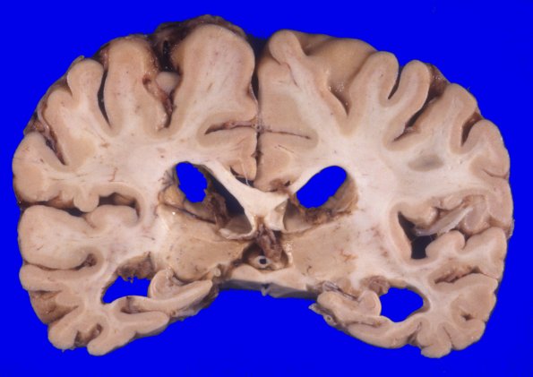 2A8 NIID & Alzheimer Dz (NIID, Case 2) A7