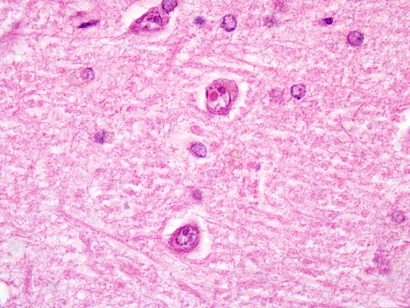 2B2 NIID & Alzheimer Dz (NIID, Case 2) HC H&E 11.jpg