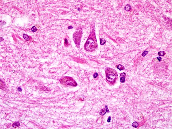 2B3 NIID & Alzheimer Dz (NIID, Case 2) HC H&E 12.jpg