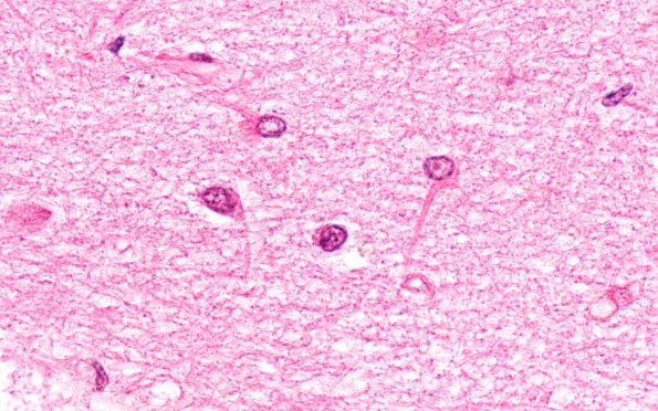 2B7 NIID & Alzheimer Dz (NIID, Case 2) H&E 100X 1